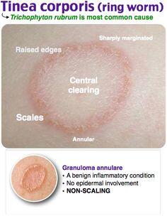 Tinea corporis