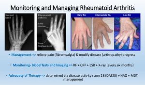 Azulfidine (Sulfasalazin)